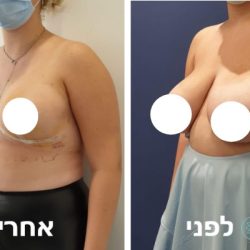 Breast-reduction-before-and-after-3